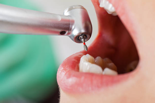 Best Emergency Tooth Extraction in San Castle, FL